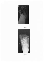 Способ устранения неригидных молоткообразных деформаций 2, 3, 4 пальцев при поперечном плоскостопии (патент 2610335)