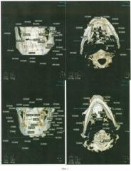 Способ идентификации личности человека методом компьютерной томографии (кт) (патент 2510239)