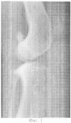 Биоимплантат для возмещения дефектов минерализованных тканей и способ его получения (патент 2311167)