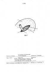 Способ лечения стеноза устья мочеточника у детей (патент 1378821)