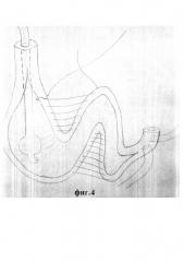 Способ гетеротопической тонкокишечной пластики мочевого неоцистиса (патент 2654576)