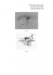 Способ васкулярной изоляции опухолевого тромба нижней полой вены при раке почки (патент 2661081)
