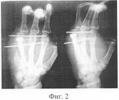 Способ замещения дефекта четвертой пястной кости и мягких тканей кисти (патент 2300339)