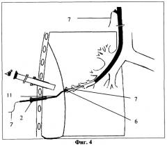 Способ селективной пломбировки бронхоплевральных свищей (патент 2269940)