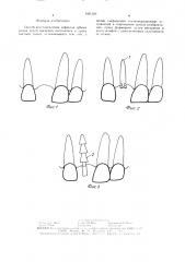 Способ восстановления дефектов зубных рядов (патент 1491503)