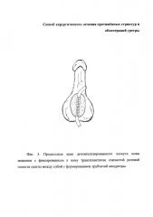 Способ хирургического лечения протяжённых стриктур и облитераций уретры (патент 2657939)