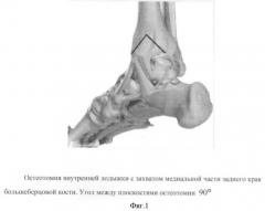 Способ оперативного доступа к таранной кости (патент 2431449)