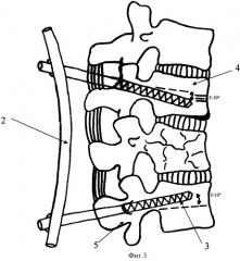 Способ лечения множественных переломов позвоночника у детей (патент 2370236)