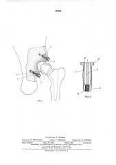 Узел тазобедренной чашки протеза бедра (патент 484662)