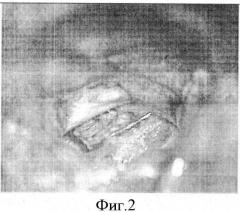 Способ микродискэктомии с пластикой фиброзного кольца и сохранением желтой связки (патент 2570167)