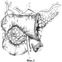 Способ хирургического лечения осложненных низких дуоденальных язв с поражением большого и малого дуоденальных сосочков (патент 2312609)