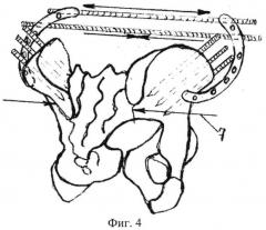 Способ артродезирования крестцово-подвздошного сочленения (патент 2543854)