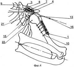 Внутренний фиксатор для артродеза плечевого сустава (патент 2343866)