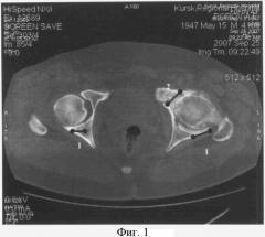 Способ диагностики локальных участков компрессии тазобедренного сустава у больных коксартрозом методом компьютерной томографии (патент 2377954)