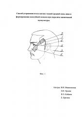 Способ устранения птоза мягких тканей средней зоны лица и формирования носогубной складки при параличе мимической мускулатуры (патент 2633344)