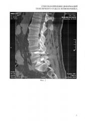 Способ коррекции деформаций поясничного отдела позвоночника (патент 2621170)