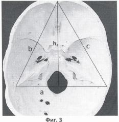 Стереокраниобазиометр (патент 2362506)