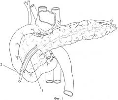 Способ хирургического лечения наружных панкреатических свищей (патент 2447839)