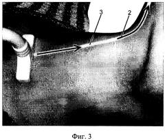 Способ ультразвукового исследования лимфатических узлов шеи (патент 2441595)