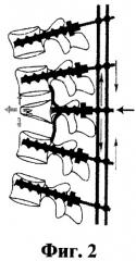 Способ вертебропластики при переломах тел позвонков (патент 2462206)