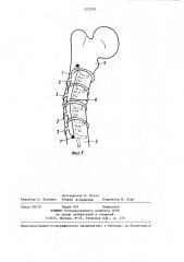 Устройство для остеосинтеза (патент 1375251)