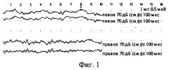 Способ лечения тяжелой черепно-мозговой травмы (патент 2262356)