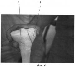 Способ лечения импрессионного перелома метаэпифизарного отдела трубчатой кости (патент 2444319)