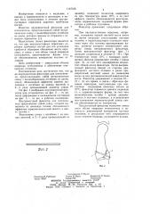 Внутрикостный фиксатор для остеосинтеза (патент 1147378)