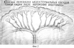 Способ профилактики внутрибрюшного спайкообразования при хирургических вмешательствах на кишечнике (патент 2325169)