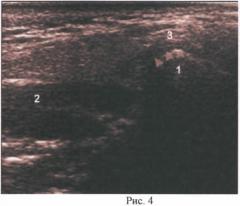 Способ лечения заболеваний височно-нижнечелюстного сустава, сопровождающихся передним смещением и деформацией суставного диска (патент 2480174)