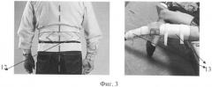 Экстракорпоральный ортопедический дистрактор (патент 2424784)