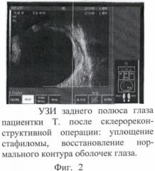 Способ склерореконструктивного лечения высокой близорукости (патент 2367394)