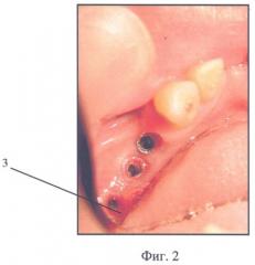 Устройство для формирования десневого канала зубного протеза (патент 2318467)