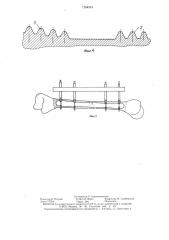 Устройство для фиксации фрагмента трубчатой кости (патент 1284533)