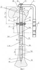 Устройство для лечения сложных переломов бедренной кости (патент 2271171)