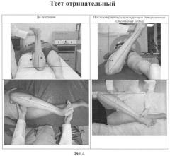 Способ определения причины внутренней ротационной дисфункции в тазобедренном суставе у больных с детским церебральным параличом (патент 2432115)