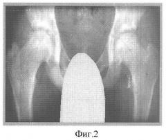 Способ лечения асептического некроза головки бедренной кости и болезни пертеса (патент 2357736)