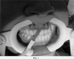 Средство для фиксации десневых электродов при проведении реопародонтографии (патент 2290862)