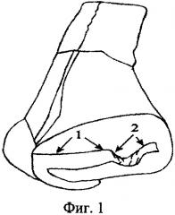 Способ реконструкции наружного носового клапана при его дисфункции (патент 2627351)