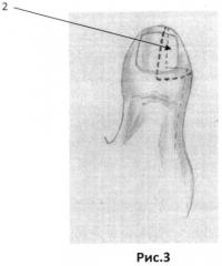 Способ восстановления ногтевого матрикса пальца кисти (патент 2494682)