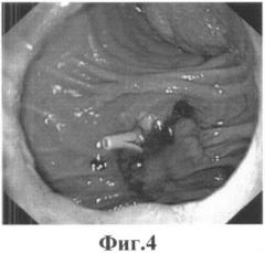 Способ лечения панкреатических затеков после трансплантации поджелудочной железы (патент 2549995)