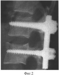 Способ моносегментарной транспедикулярной стабилизации переломов тел нижних грудных и поясничных позвонков (патент 2485904)