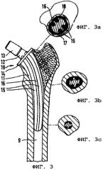Протезная система (патент 2259178)