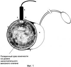 Способ определения диаметра корригирующего устройства для устранения недостаточности венозного клапана (патент 2255658)