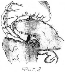 Способ хирургического лечения асептического панкреонекроза (патент 2557417)