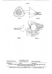 Эндопротез нижней стенки глазницы (патент 1725875)