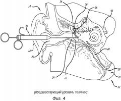 Система для лечения целевой ткани в евстахиевой трубе (патент 2559017)