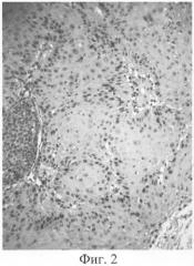 Способ дифференциальной диагностики плоскоклеточного рака кожи и кератоакантомы (патент 2279089)