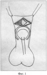 Способ хирургического лечения дистальной гипоспадии у мальчиков (патент 2428124)
