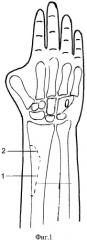 Способ профилактики перелома лучевой кости при пластике 
